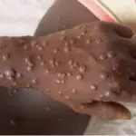 Mpox in Bafang: health alert and immediate strengthening of surveillance in the West region