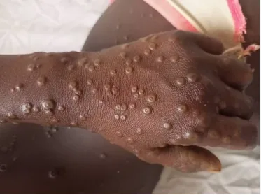 Mpox in Bafang: health alert and immediate strengthening of surveillance in the West region